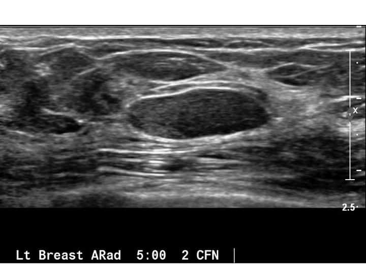 Differentiating Hypoechoic Breast Masses: Is Further Evaluation Necessary?