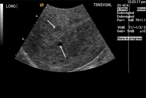Learn more about Sonographic Evaluation of Uterine Leiomyomas and Adenomyosis: Earn 1 CME Credit with Our ACCME-Accredited Course