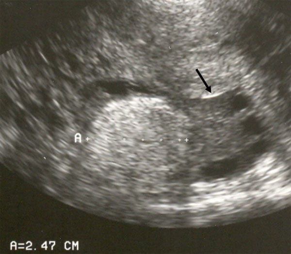 Ultrasound Imaging: Unraveling the Mystery of Benign and Malignant Ovarian Cysts