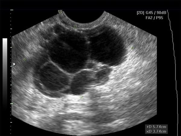 Ultrasound showing an loculated cyst