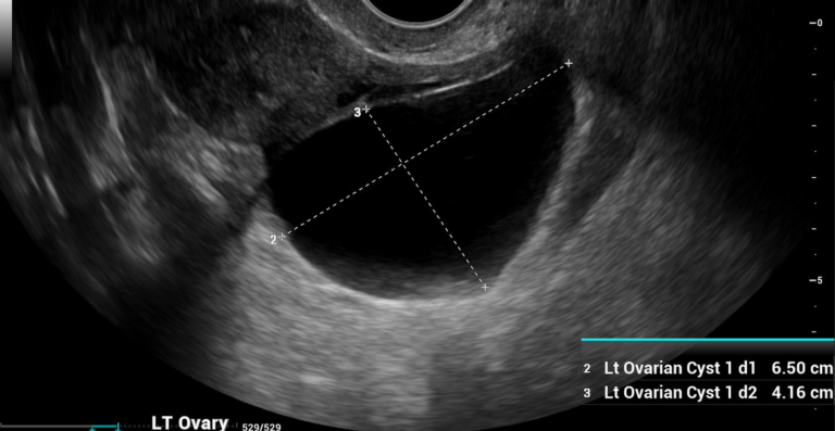 Ultrasound Imaging: Differentiating Between Benign and Malignant Ovarian Cysts