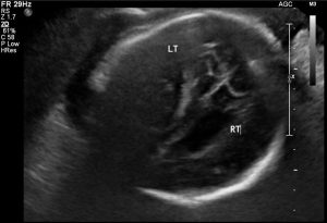 
Sonographic Assessment of Congenital Cytomegalovirus, infection, fetal, serological
