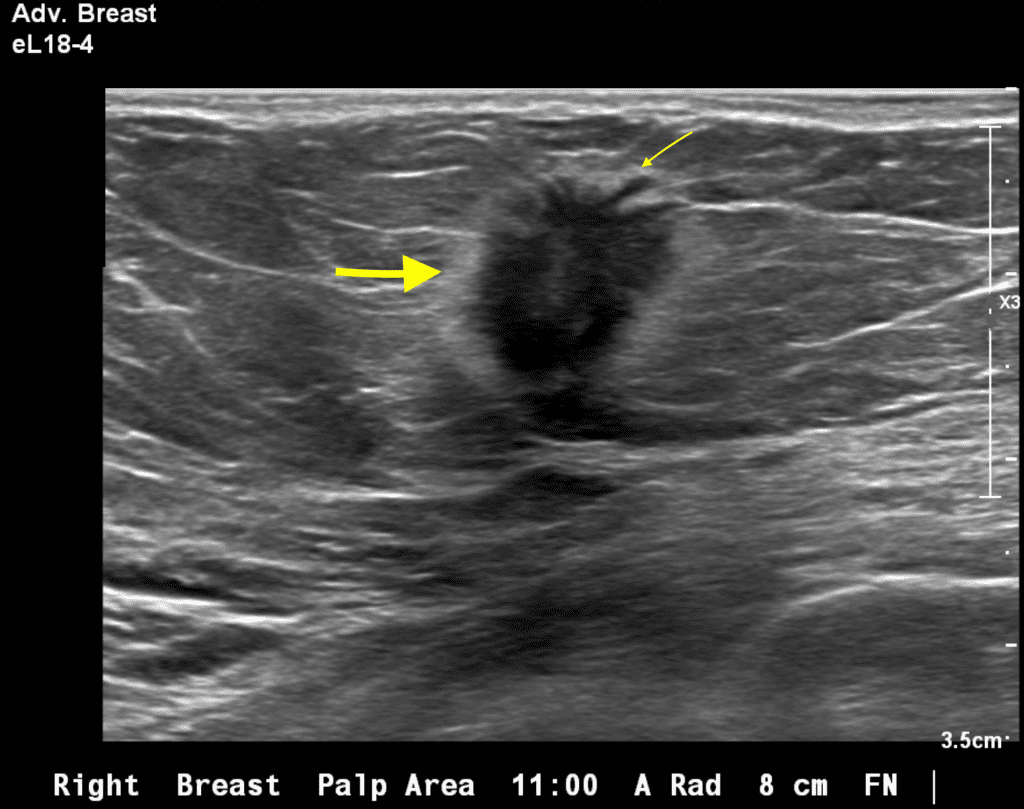 Ultrasound Guided Breast Biopsy, ultrasound, medical